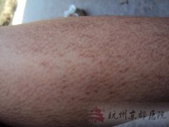 鱼鳞病是一种怎样的病