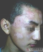 白癜风患者在饮食方面该如何护理