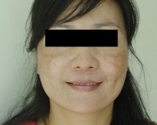 黄褐斑患者在生活中注意事项