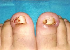 日照石臼港口医院治疗甲沟炎要多少钱啊