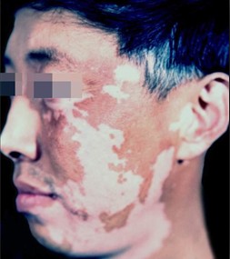 北大专科医生提醒白癜风患者应避免暴晒
